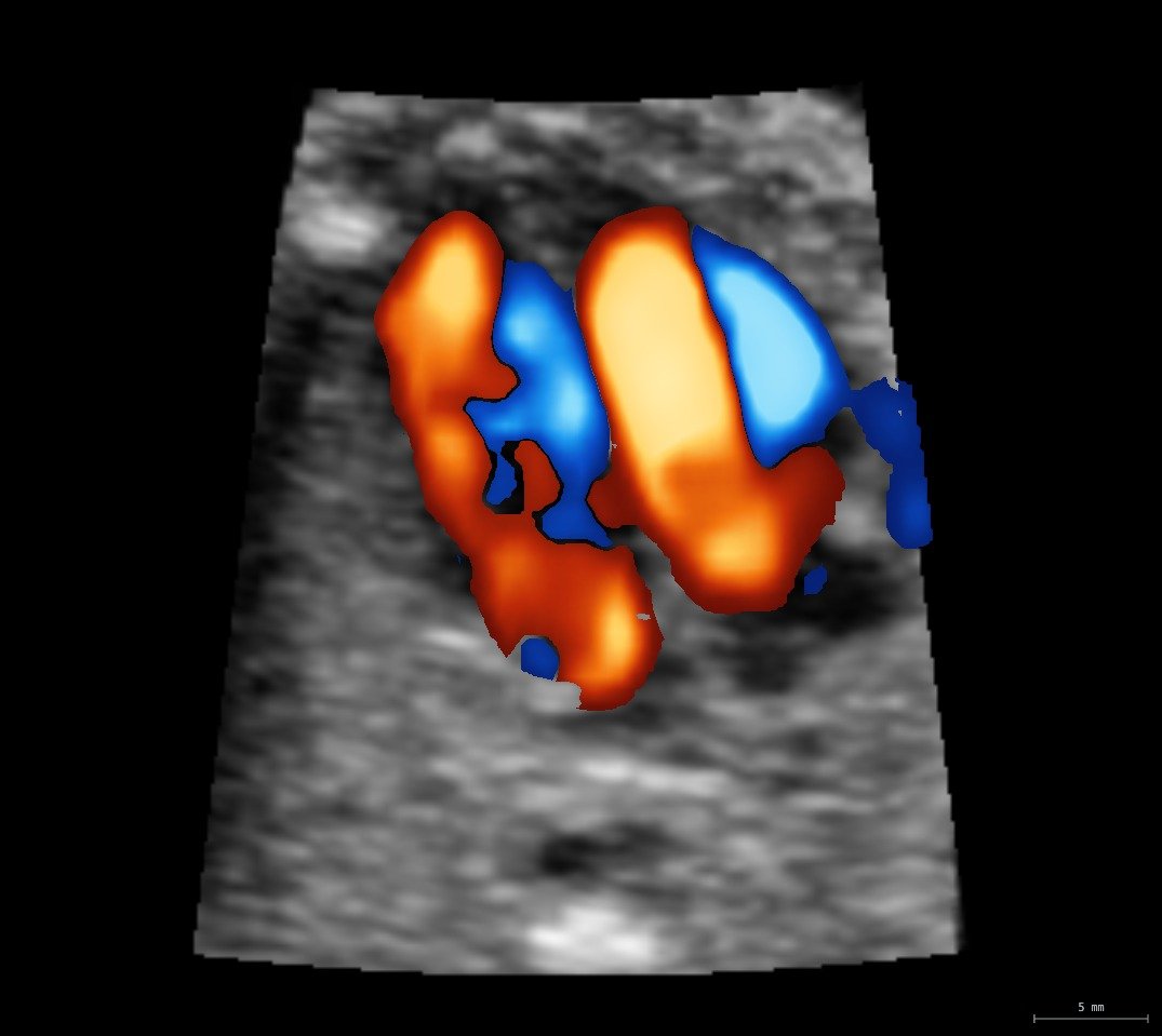 Cuatro cámaras en el mismo volumen STIC con Doppler color