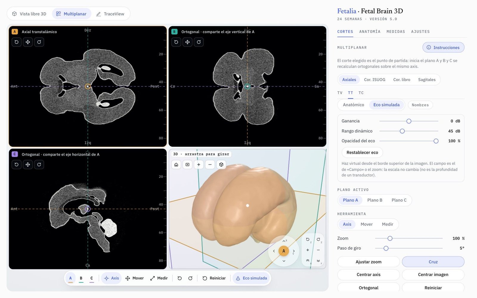Modo Multiplanar de Fetal Brain 3D: planos A, B y C del axial transtalámico en eco simulada y la vista 3D