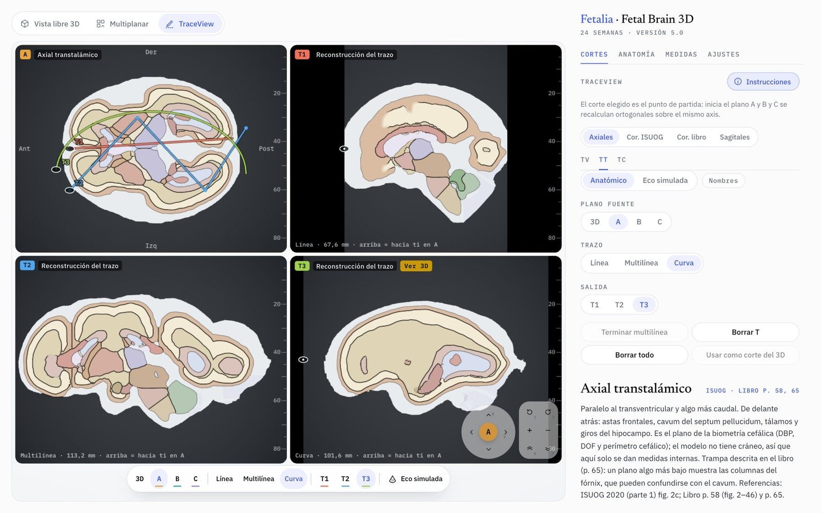 Modo TraceView de Fetal Brain 3D: una línea, una multilínea y una curva sobre el axial transtalámico y sus reconstrucciones T1, T2 y T3