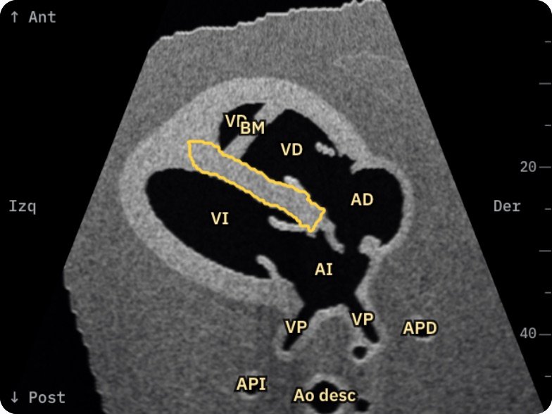 Cuatro cámaras en la imagen ecográfica simulada de Fetal Heart 3D