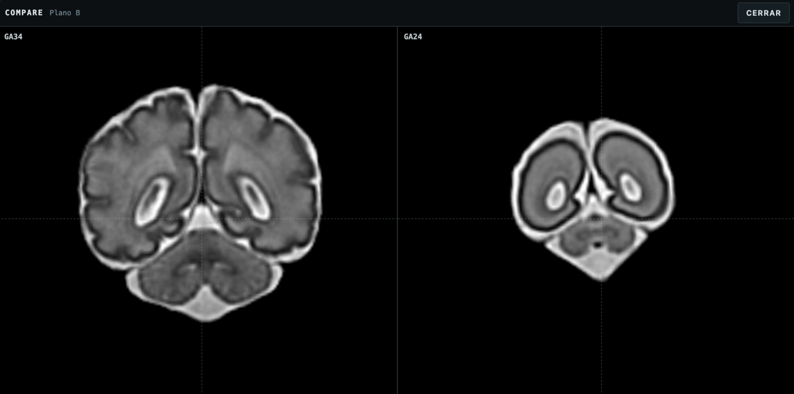 Comparación de dos edades gestacionales en Fetalia NeuroAtlas con una referencia anatómica común