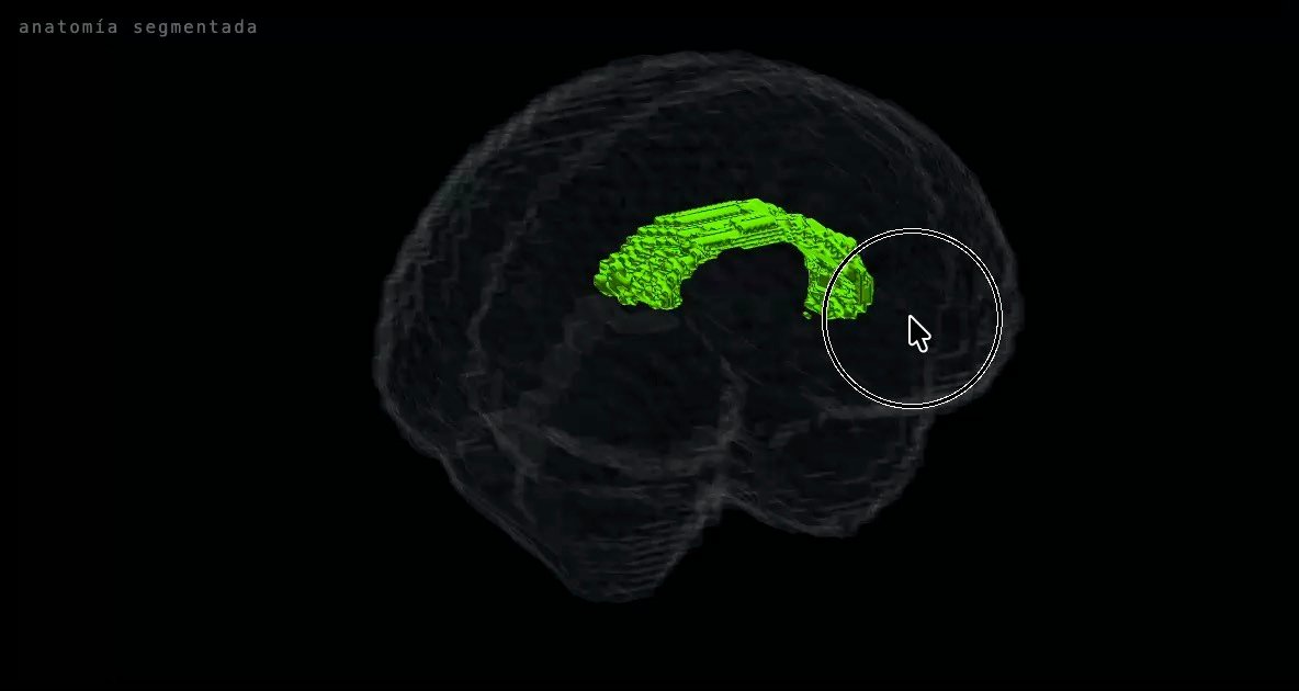 Representación tridimensional del cuerpo calloso y su relación con la anatomía cerebral en Fetalia NeuroAtlas