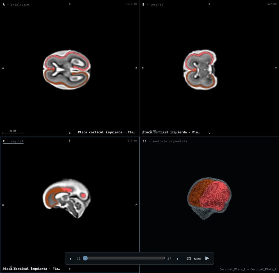 Placa cortical a las 21 semanas en Fetalia NeuroAtlas: planos axial, coronal y sagital y vista 3D