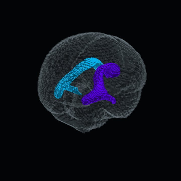 Los ventrículos laterales en 3D dentro del cerebro translúcido, en modo Contexto
