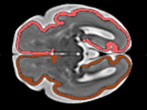 Placa cortical a las 29 semanas