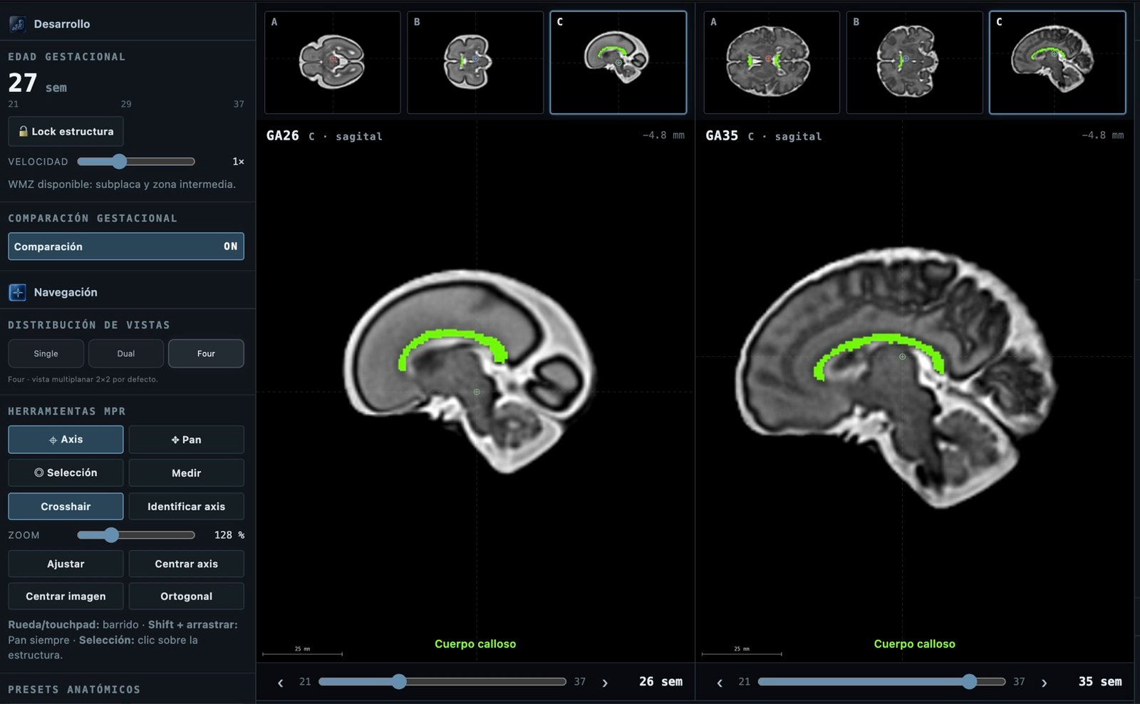 Modo Comparación de Fetalia NeuroAtlas: corte sagital con el cuerpo calloso a las 26 y a las 35 semanas
