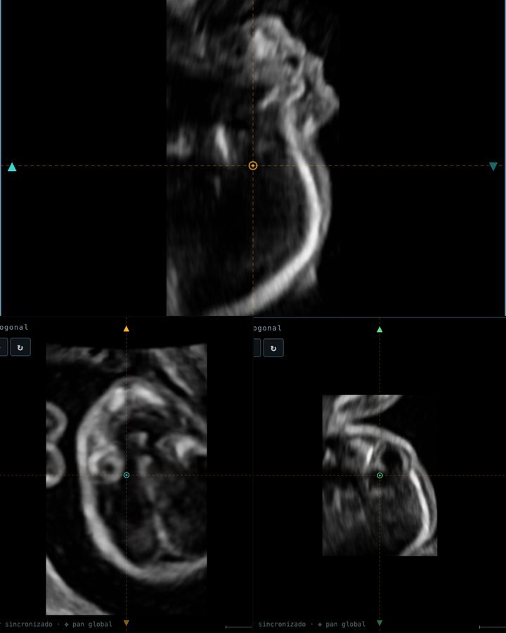 Volumen FVOL de la cara fetal en los planos A, B y C