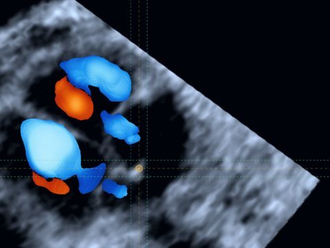 STIC con Doppler color